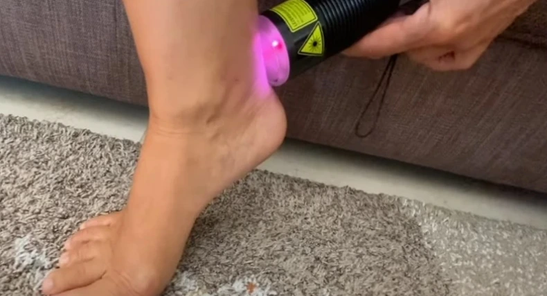 sarkantyú kezelése safe laserrel