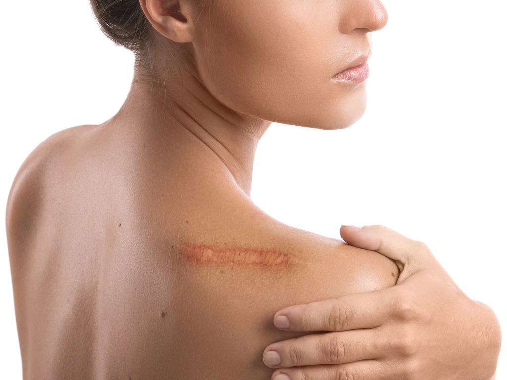 Bőrproblémák hatékony kezelése Safe Laserrel