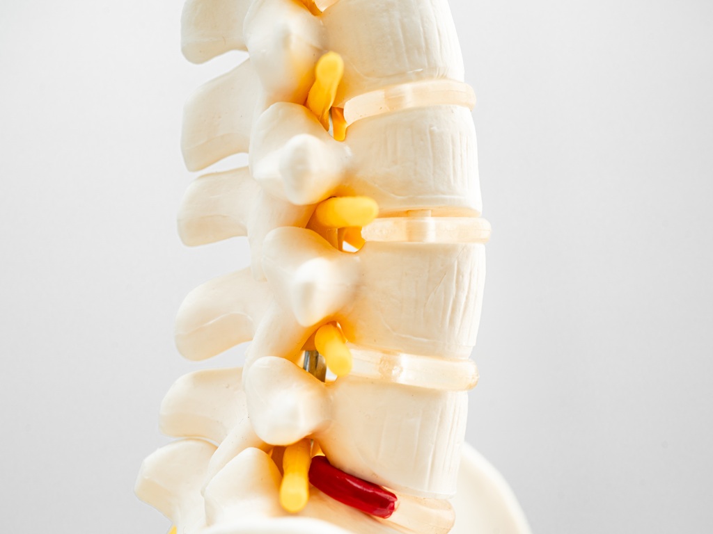 Porckorongsérv kezelése Safe Laser segítségével